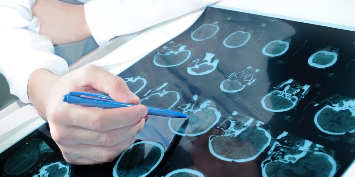 Lenkų mokslininkų revoliucija: naujas vaistų leidimo būdas žada lūžį gydant smegenų vėžį