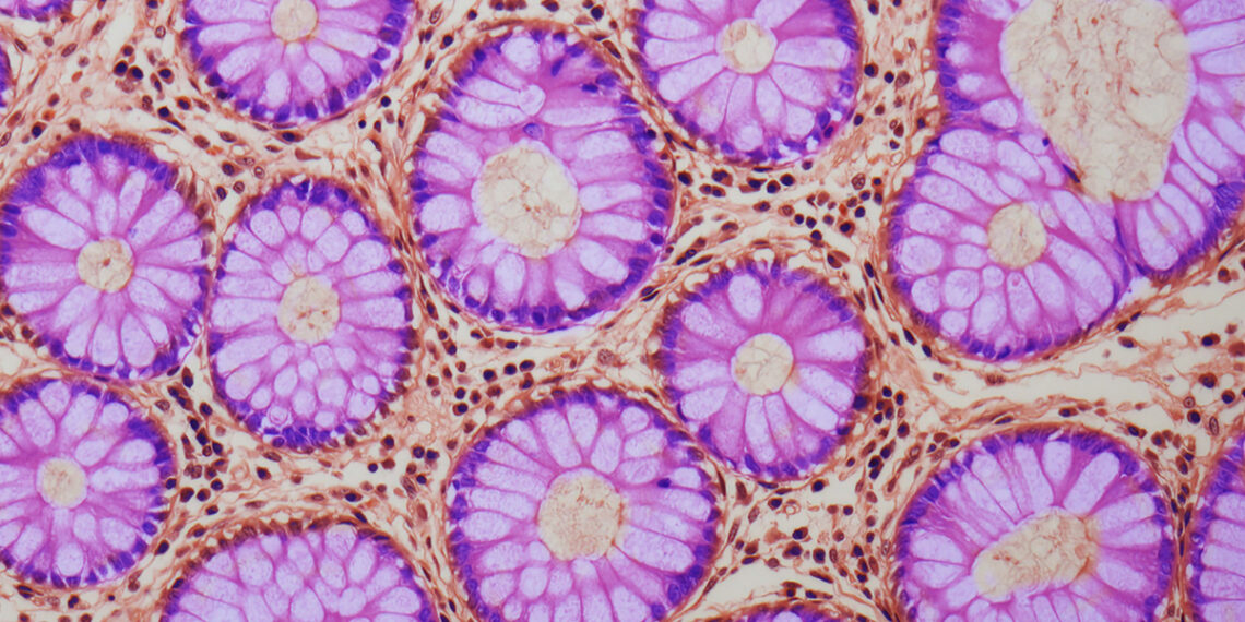 Mokslininkai šokiruoti: atrastas slaptas žarnyno požymis, didinantis vėžio riziką