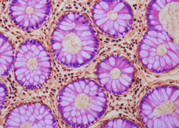 Mokslininkai šokiruoti: atrastas slaptas žarnyno požymis, didinantis vėžio riziką