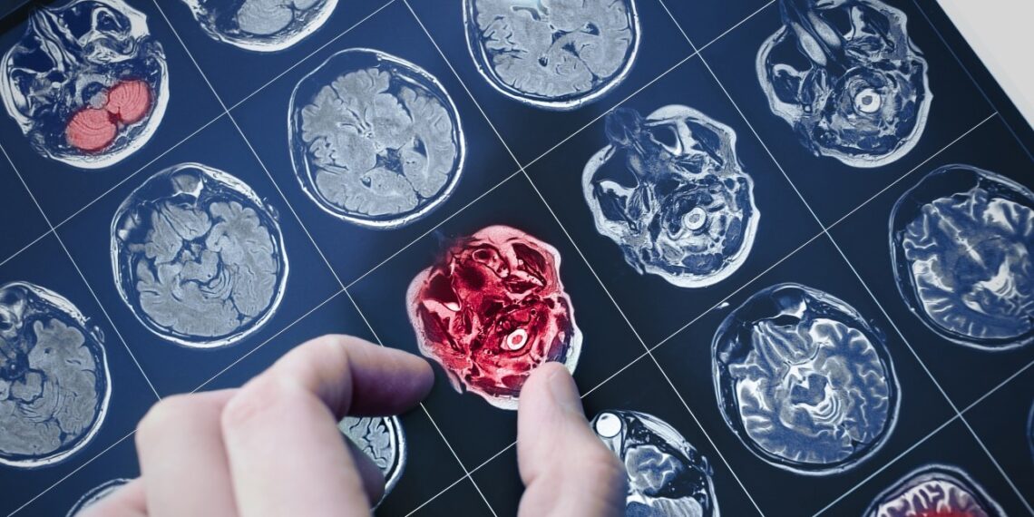 Naujas būdas atpažinti Alzheimerį: mokslininkai šią ligą nustato dar prieš pirmus simptomus