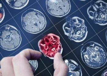 Naujas būdas atpažinti Alzheimerį: mokslininkai šią ligą nustato dar prieš pirmus simptomus