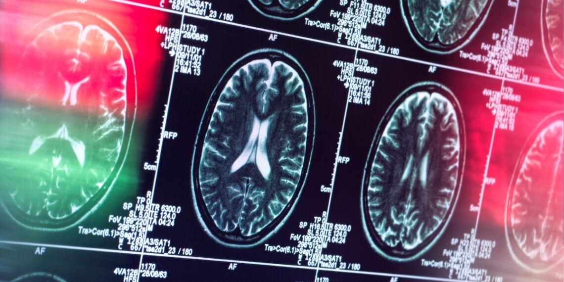 Šokiruojantis atradimas: Alzheimeris gali būti visai ne smegenų liga, perspėja ekspertai