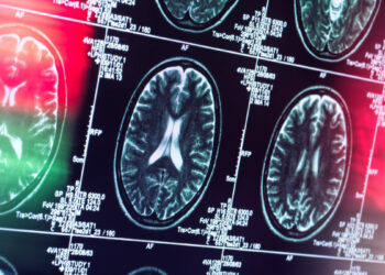 Šokiruojantis atradimas: Alzheimeris gali būti visai ne smegenų liga, perspėja ekspertai