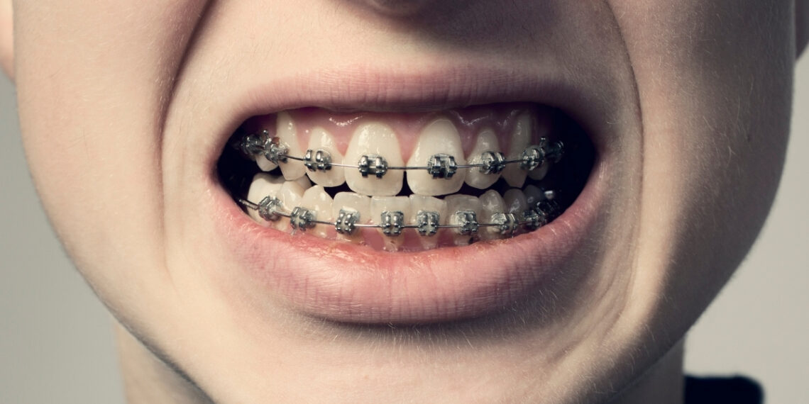 Šokiruojantis atradimas: dantų breketų istorija nėra tokia sena, kaip mums visą laiką sakė