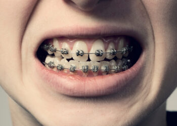 Šokiruojantis atradimas: dantų breketų istorija nėra tokia sena, kaip mums visą laiką sakė