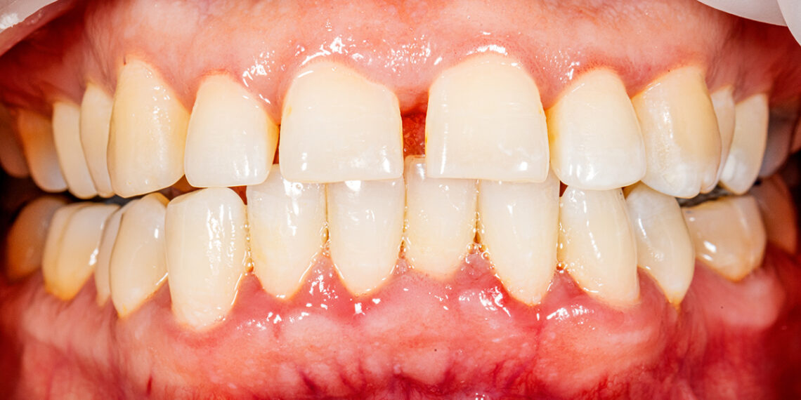 Šokiruojantis tyrimas: dantų būklė gali atskleisti, ar mirsite gerokai anksčiau laiko