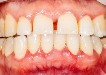 Šokiruojantis tyrimas: dantų būklė gali atskleisti, ar mirsite gerokai anksčiau laiko