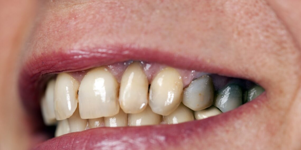 Šokiruojantys mokslininkų duomenys: kiek sveikų dantų turi vyras ar moteris, tiek metų dar gyvens?