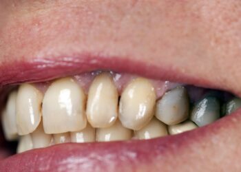 Šokiruojantys mokslininkų duomenys: kiek sveikų dantų turi vyras ar moteris, tiek metų dar gyvens?