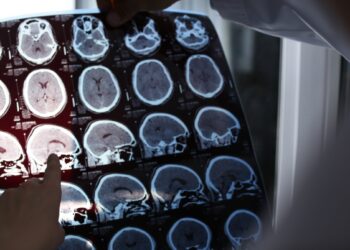 Vėžys gali „išvalyti“ smegenis? Mokslininkai atskleidė netikėtą ryšį su Alzheimeriu