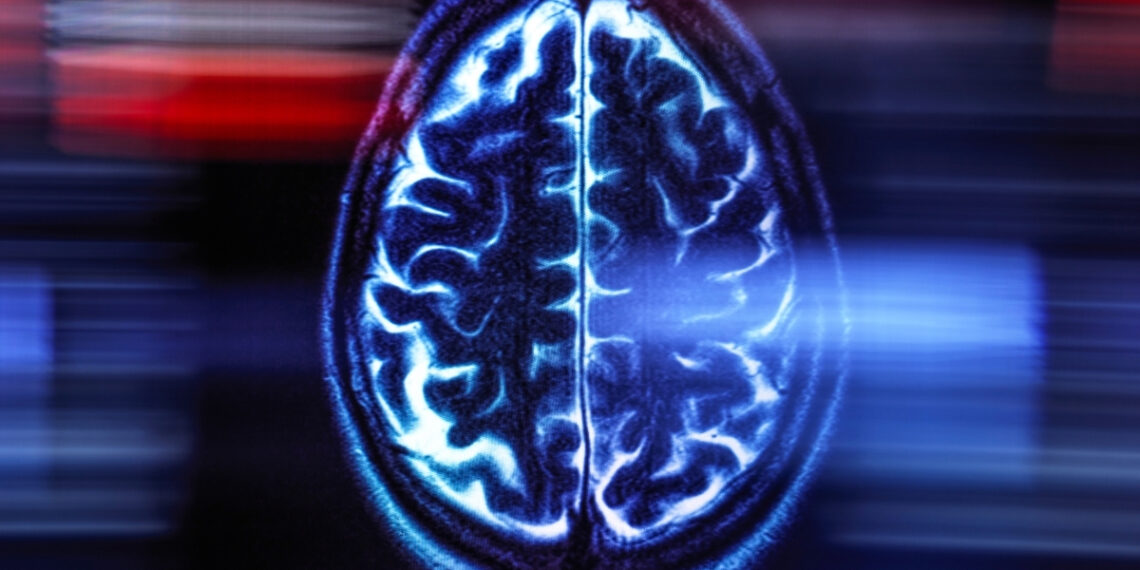 Vienas paprastas įprotis, kuris netikėtai drastiškai sumažina demencijos riziką – gydytojai šokiruoti