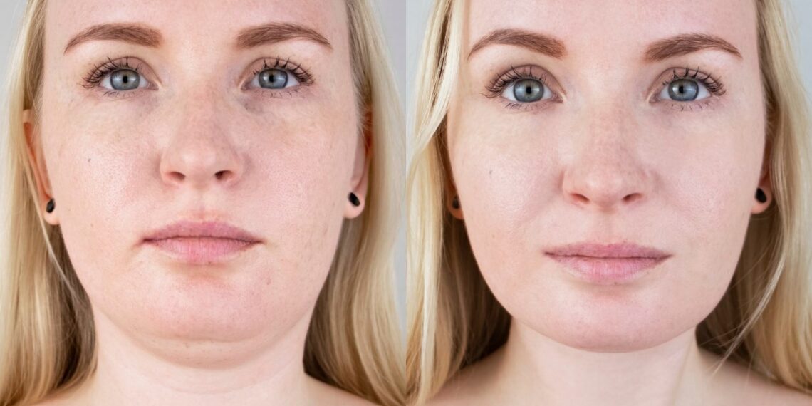 5 minučių pratimas liežuviui – ar jis gali padėti sumažinti dvigubą pagurklį?