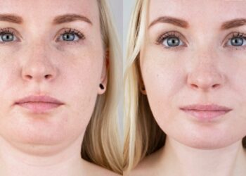 5 minučių pratimas liežuviui – ar jis gali padėti sumažinti dvigubą pagurklį?