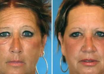 Dvynių eksperimentas šokiruoja: cigaretės ir saulė paliko ryškius pėdsakus