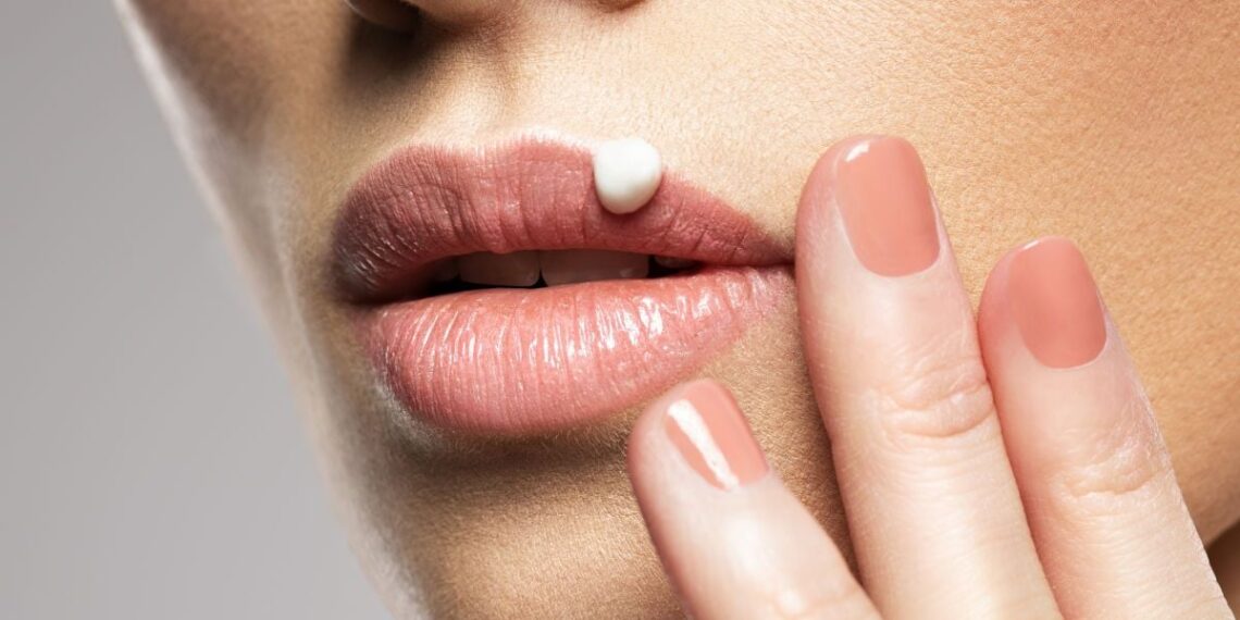 Kas išprovokuoja herpeso atsinaujinimą? Medikai įvardijo dažnas klaidas