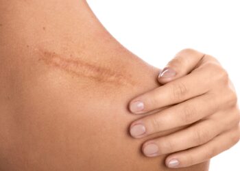 Kaip sumažinti randus ir odos nelygumus: specialistai pataria veiksmingus būdus