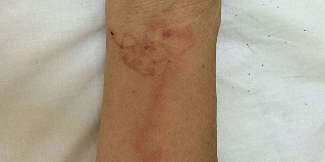 Mutuojantys parazitai pasiekė Europą: ekspertai perspėja dėl naujos tropinės ligos