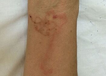 Mutuojantys parazitai pasiekė Europą: ekspertai perspėja dėl naujos tropinės ligos