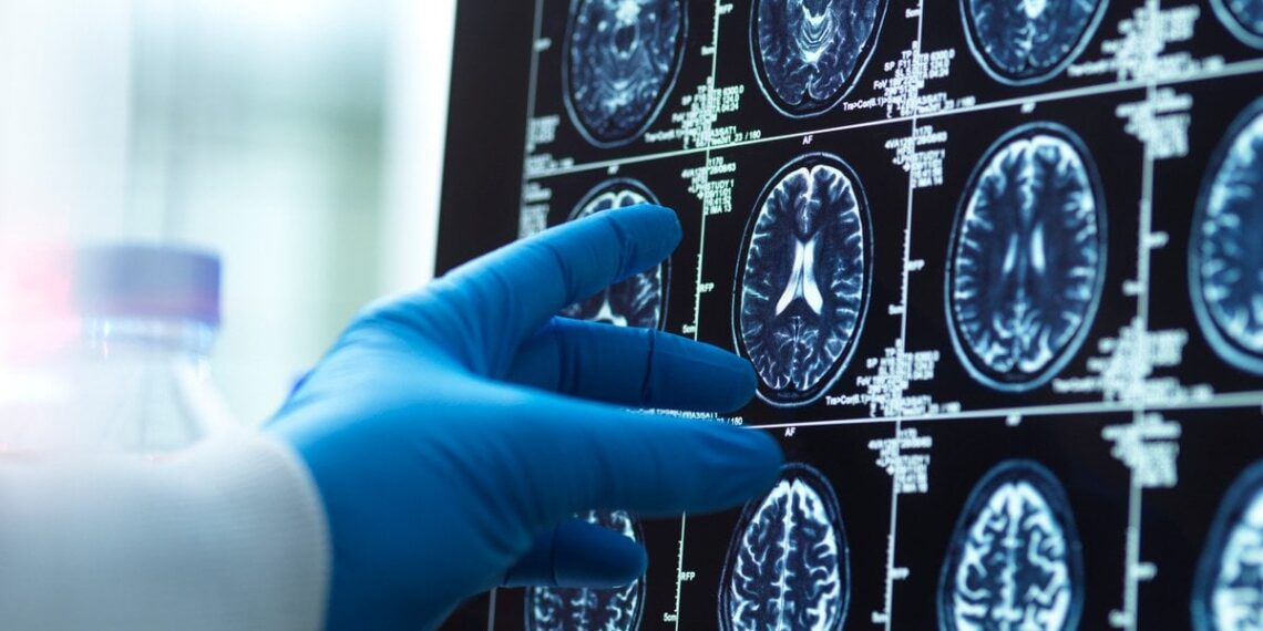 Pabundate su šiais simptomais? Jie gali būti susiję su demencijos rizika