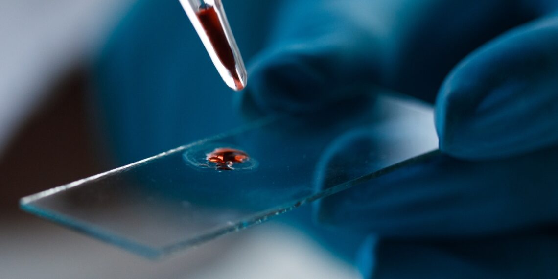 evoliucinis kraujo tyrimas: Alzheimerį gali parodyti dar prieš pirmuosius simptomus