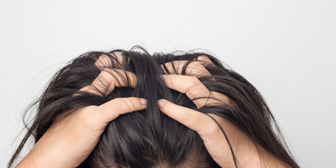 Niežtinti galvos oda gali išduoti rimtas problemas: 7 priežastys, apie kurias įspėja gydytojai