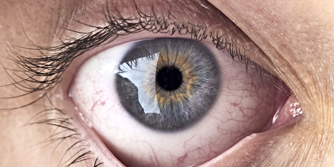 Šokiruojantis atradimas: akies dugne aptiktos bakterijos gali spartinti Alzheimerio ligą