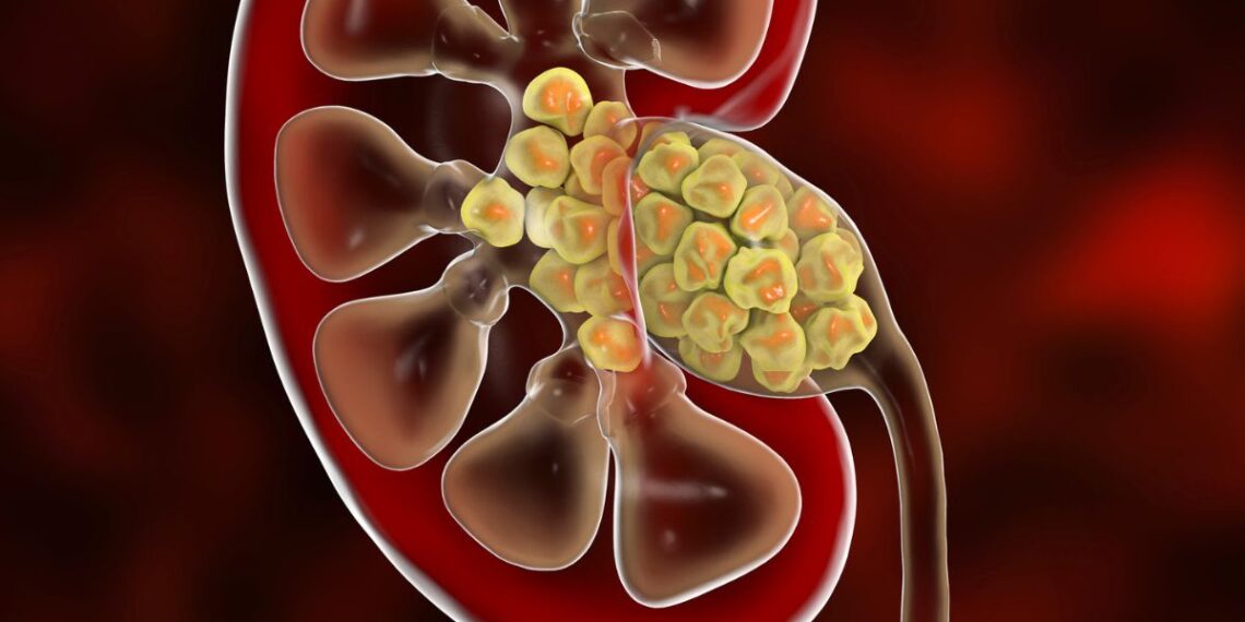 Šokiruojantis atradimas tyrinėjant inkstų akmenis: mokslininkai pripažįsta – klydome dėl jų susidarymo