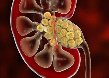 Šokiruojantis atradimas tyrinėjant inkstų akmenis: mokslininkai pripažįsta – klydome dėl jų susidarymo