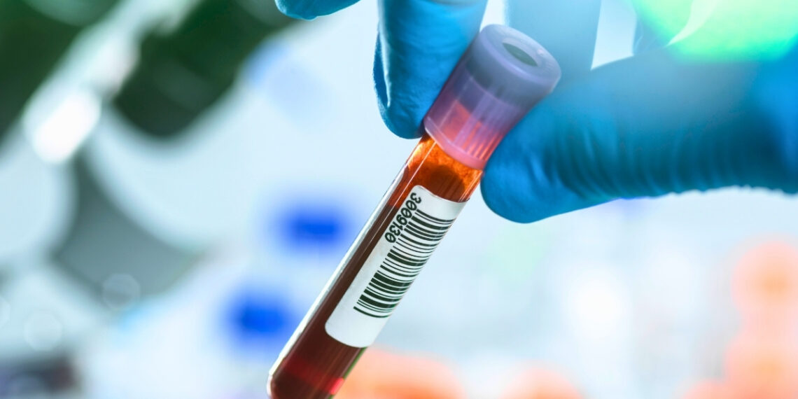 Šokiruojantis atradimas: paprastas kraujo tyrimas gali atskleisti ankstyvius Parkinsono ženklus