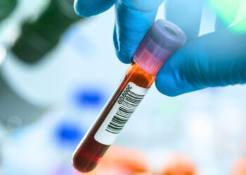 Šokiruojantis atradimas: paprastas kraujo tyrimas gali atskleisti ankstyvius Parkinsono ženklus