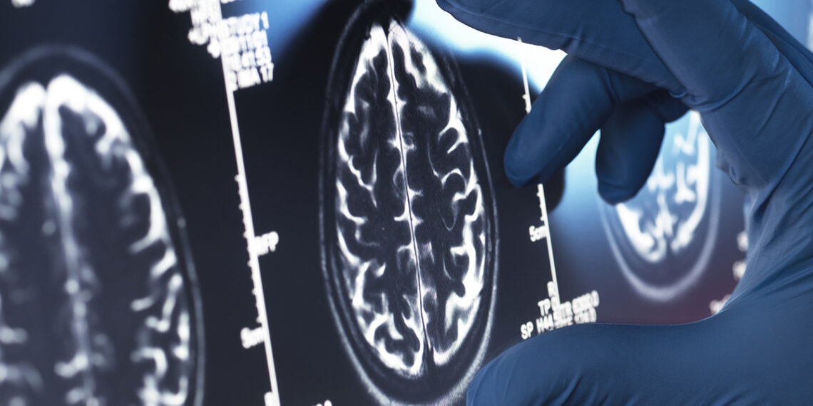 Netikėtas atradimas: populiarus vaistas nuo erekcijos sutrikimų gali padėti kovoti su Alzheimerio liga