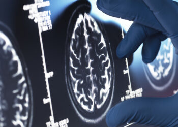 Netikėtas atradimas: populiarus vaistas nuo erekcijos sutrikimų gali padėti kovoti su Alzheimerio liga