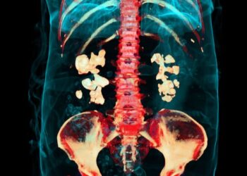 Naujas tyrimas: bakterijos gali būti susijusios su inkstų akmenų formavimusi