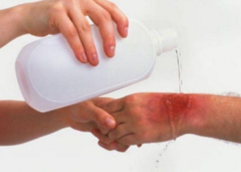 Gydytojai įspėja: ši klaida gydant nudegimą namuose gali turėti rimtų pasekmių